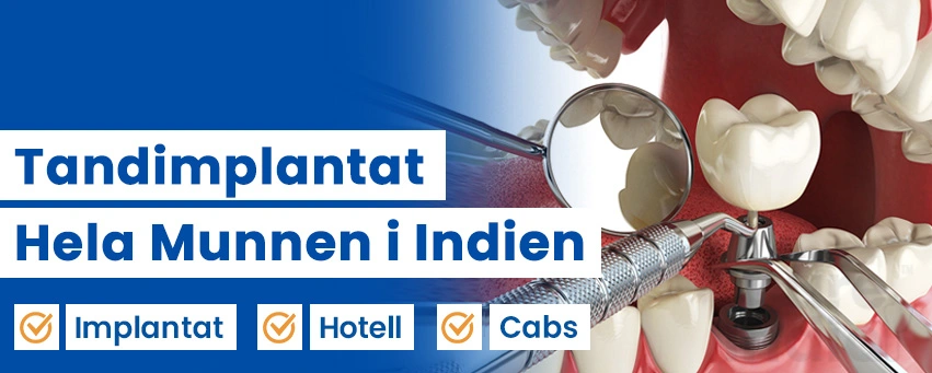Tandimplantat för Hela Munnen