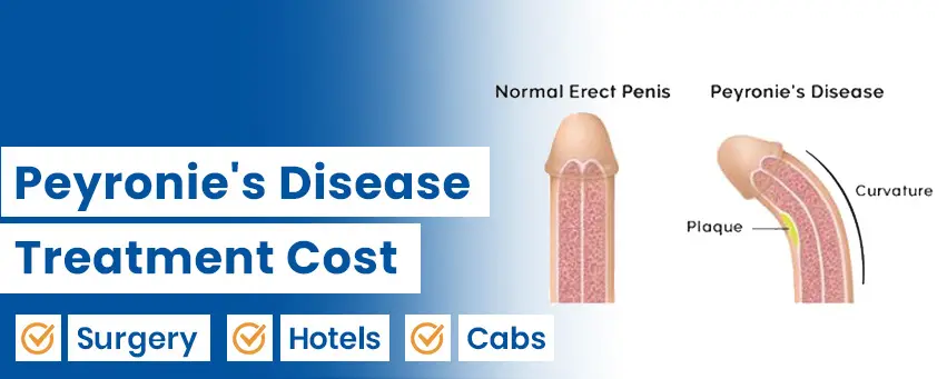 Peyronie’s Disease Treatment Cost