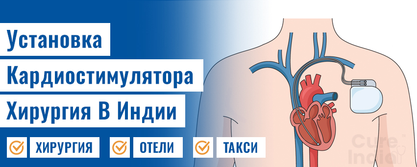 Установка кардиостимулятора
