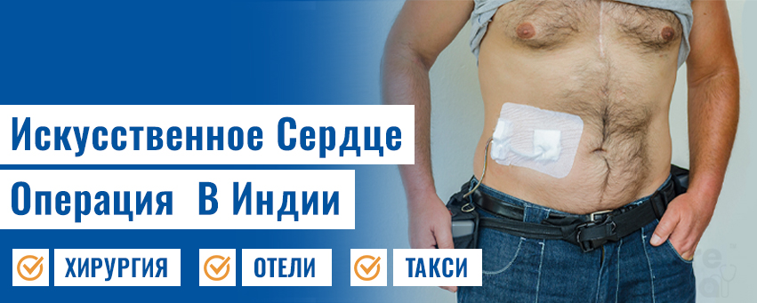 Искусственное сердце или LVAD
