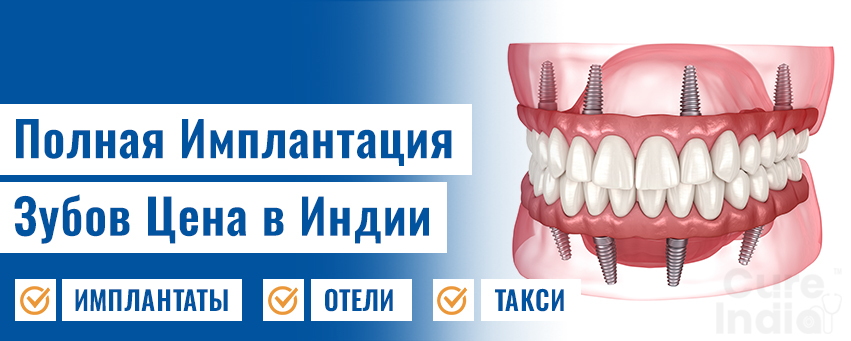 Полная Имплантация Зубов Цена