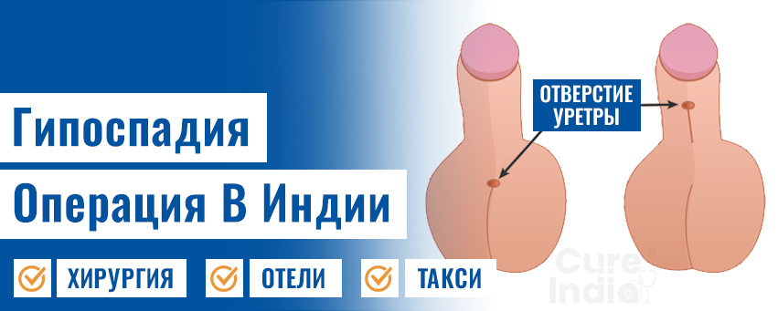 Гипоспадия Операция