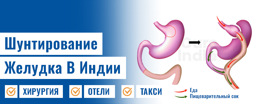Шунтирование Желудка