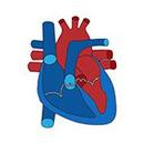 Transcatheter Aortic Valve Replacement (TAVR)