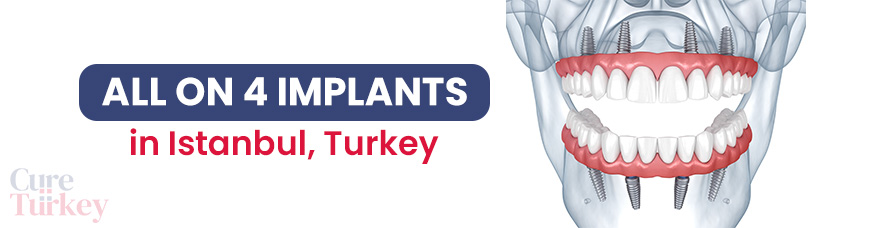 All-on-4 Implants - Istanbul