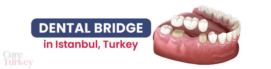 Dental Bridge in Istanbul