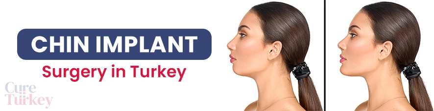 Chin Implant