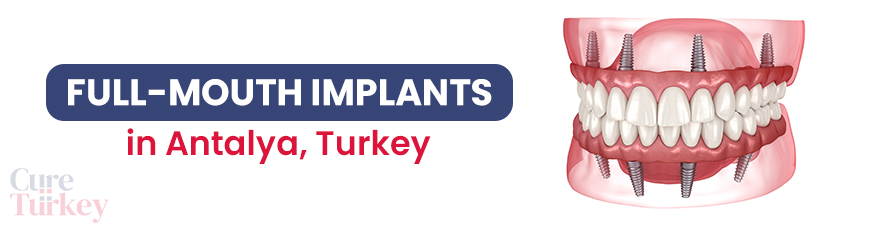 Full Mouth Dental Implants - Antalya