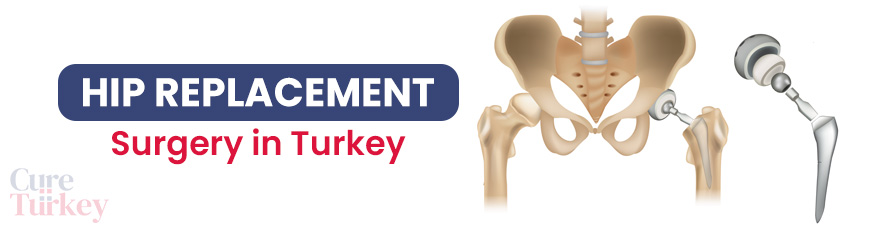 Hip Replacement