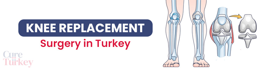Knee Replacement