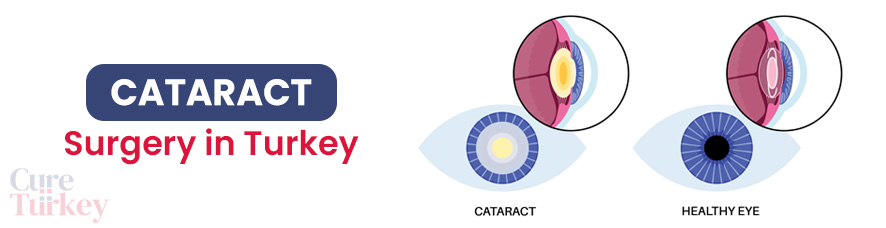 Cataract Surgery