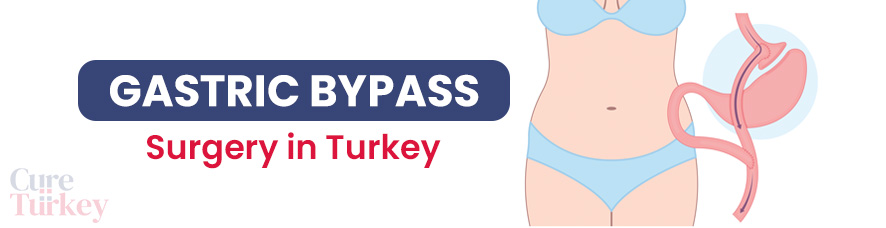 Gastric Bypass