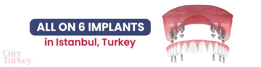 All-on-6 Implants - Istanbul