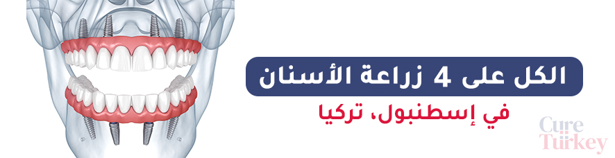 زراعة الأسنان الكل على 4 - إسطنبول