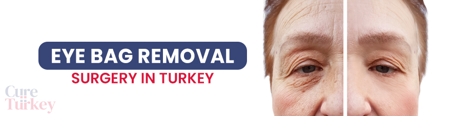 Eye Bag Removal Surgery
