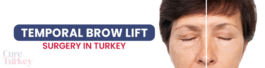 Temporal Brow Lift