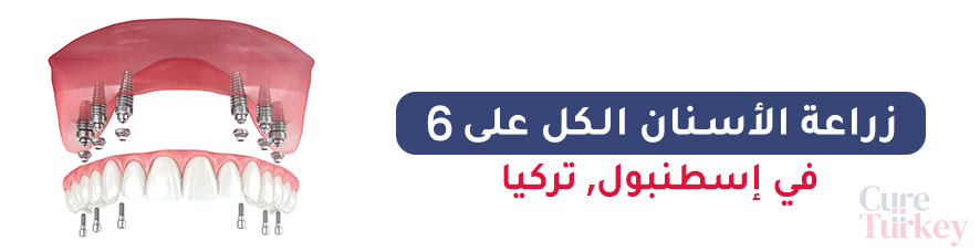زراعة الأسنان الكل على 6