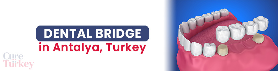 Dental Bridge in Antalya