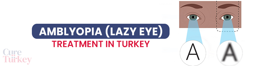 Amblyopia (Lazy Eye) Treatment