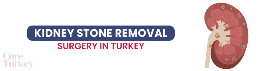 Kidney Stone Removal Surgery