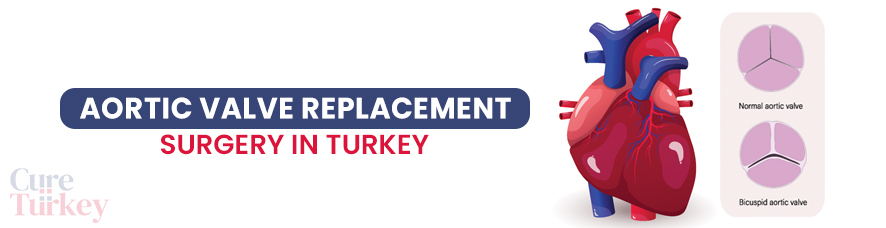 Aortic Valve Replacement