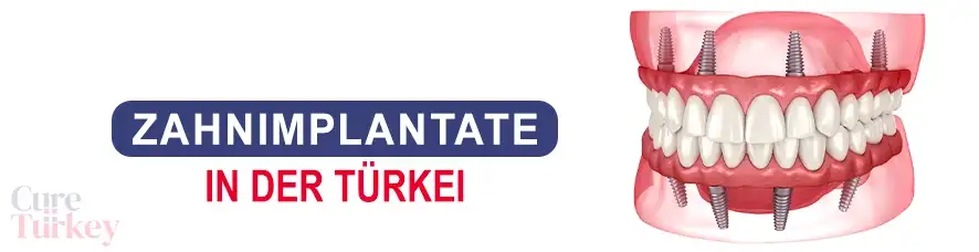 Komplett-Zahnimplantate
