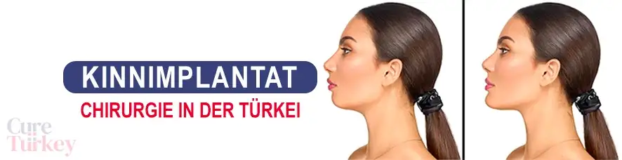 Kinnimplantat
