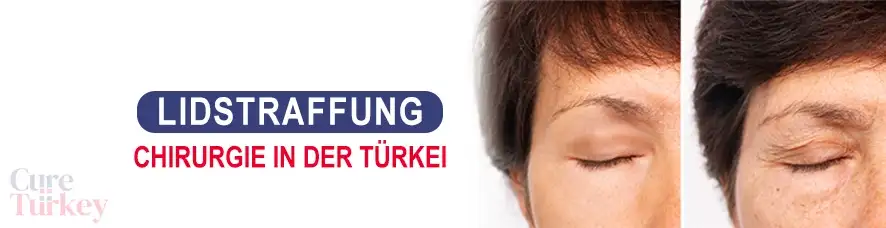 Lidstraffung