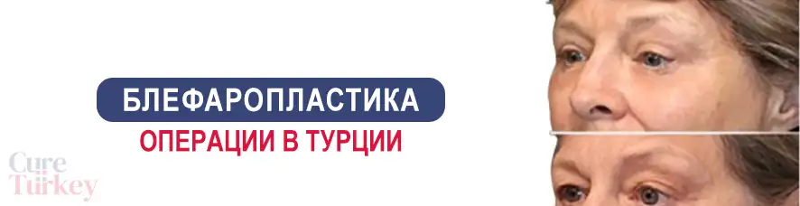 Блефаропластика