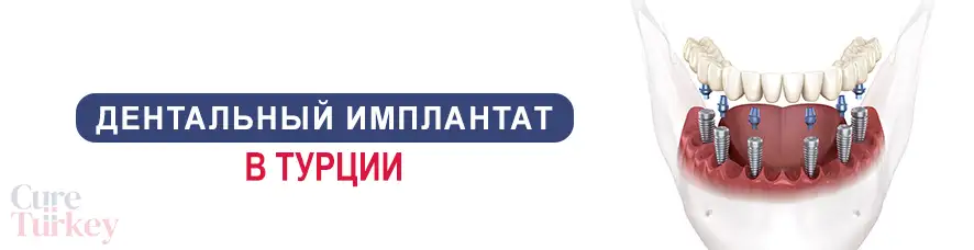 Все на 6 имплантах