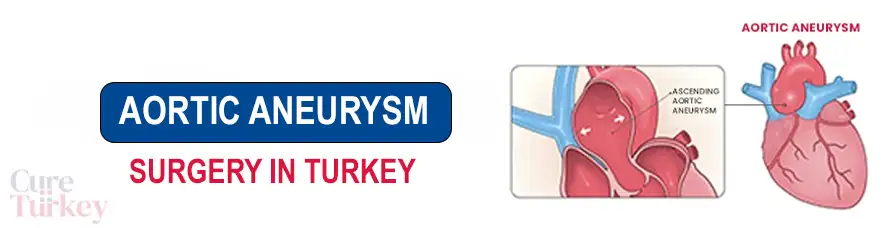 Aortic Aneurysm